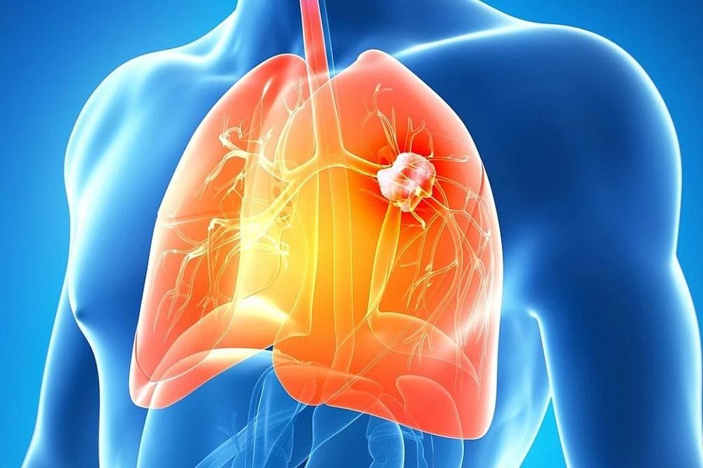 Βρογχίτιδα: Θεραπεία για την αρνητική εξέλιξη σε ένα κρυολόγημα